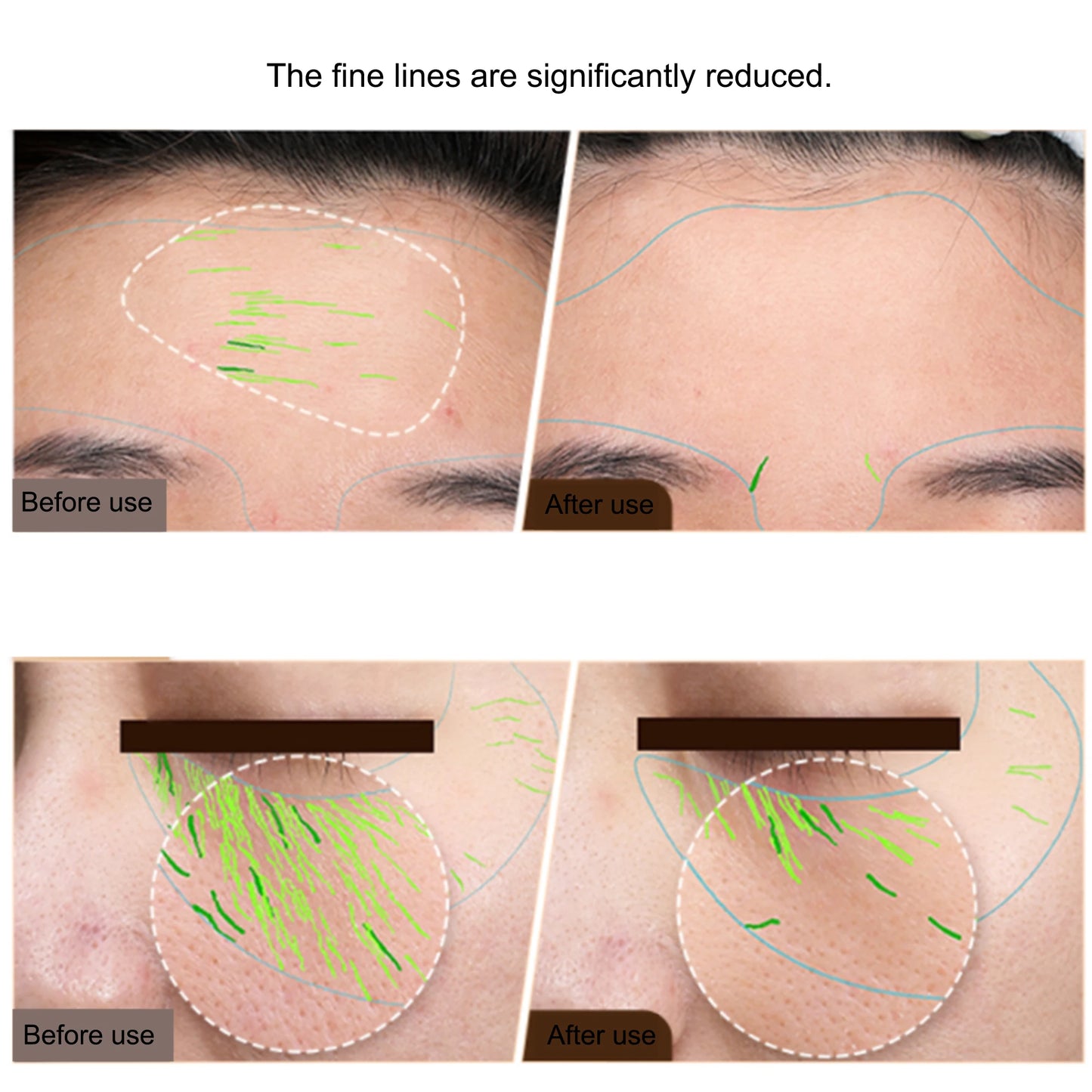 Radiofrequency skin tightening and anti-aging device